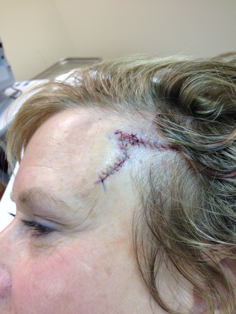 2014-03-05 11-45-24 Basal Cell Carcinoma surgery.jpg